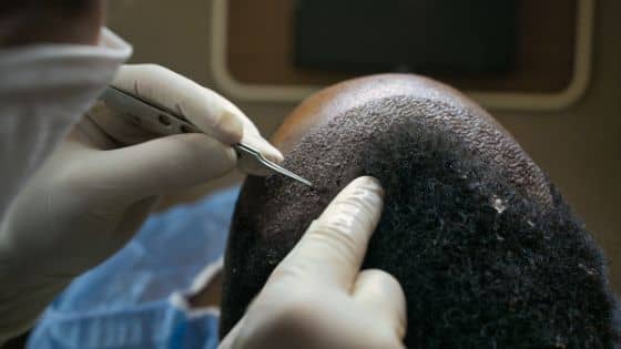 Success Rates of Different Types of Hair Transplants